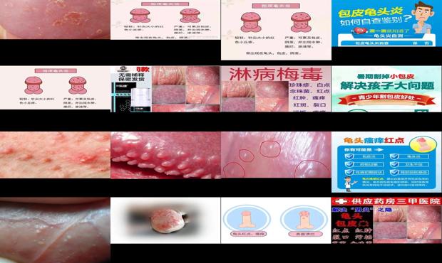 汕头男科医院在哪 - 汕头男性包皮炎症状