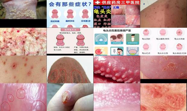 汕头男科性疾病 - 汕头龟头炎症感染