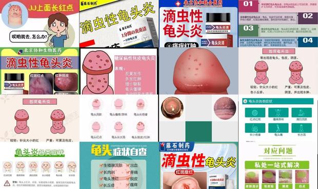滴虫菌怎么治疗 - 汕头滴虫龟头炎症状
