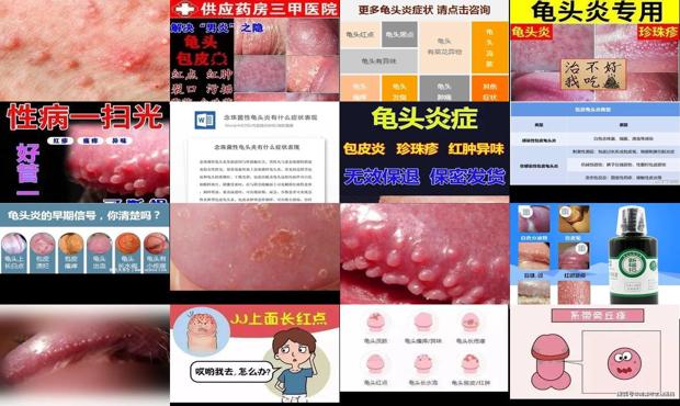念珠状发 - 汕头念珠性龟炎症状