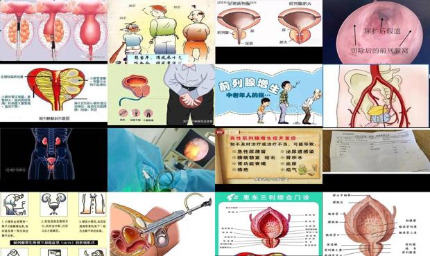 汕头前列腺手术 - 汕头前列腺并发症
