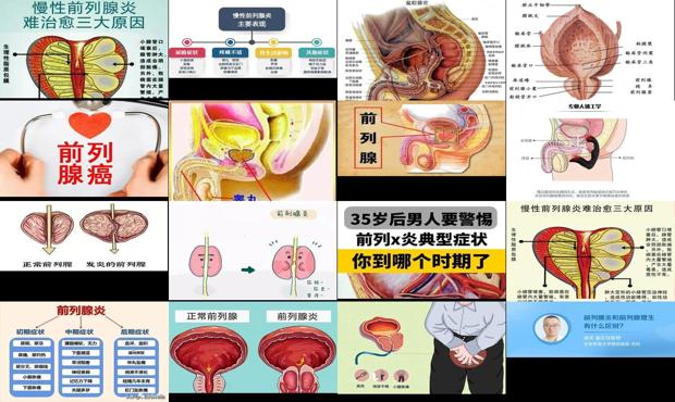 汕头前列腺炎症医院排名 - 汕头前列腺炎症状图