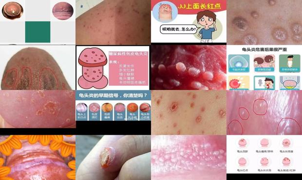 汕头男科性疾病 - 汕头龟头炎症状的图片什么样