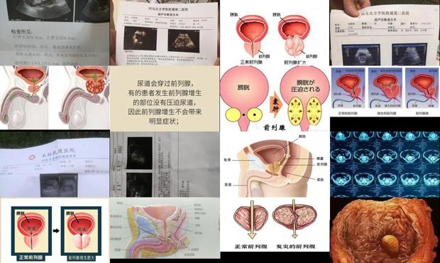 前列腺稍大是什么意思?严重吗 - 汕头前列腺稍大