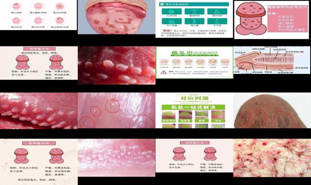 汕头男科性疾病 - 汕头龟头炎症状区分