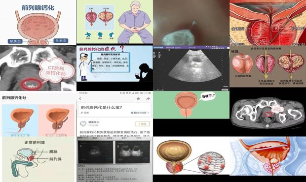 汕头前列腺钙化医院 - 汕头前列腺钙化是怎么回事