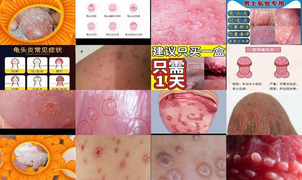 汕头有男性男科医院吗 - 汕头男性龟头炎症状图片