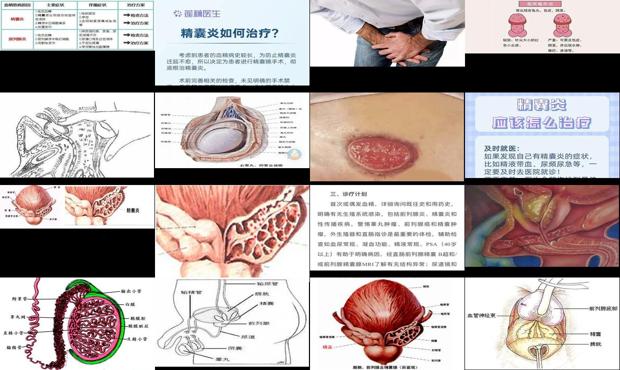 男性精囊炎的治疗 - 汕头男性精囊炎症状