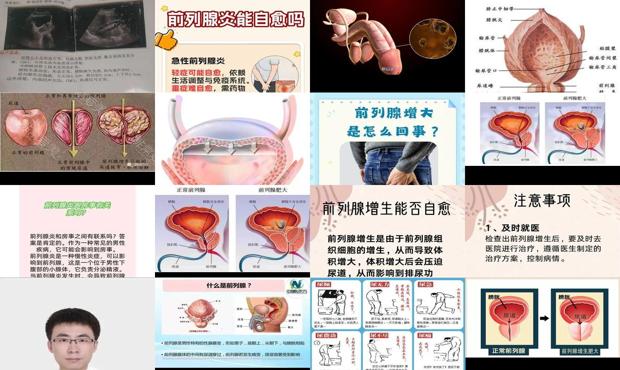 前列腺增大真的能看好吗 - 汕头前列腺增大可以自愈吗