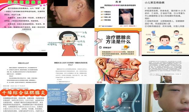 腮腺炎的预兆 - 汕头腮腺炎症状治疗方法