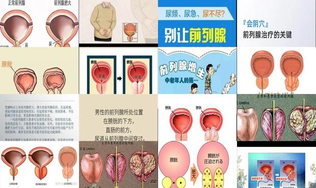 前列腺肥大根治方法 - 汕头前列腺肥大原因