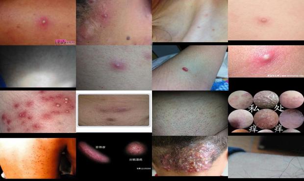 男性阴囊毛囊炎是什么原因 - 汕头男性阴毛囊炎症状