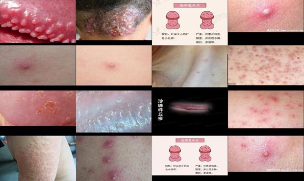 男性头部毛囊炎怎么治疗 - 汕头龟头毛囊炎症状图片
