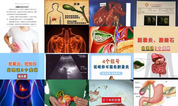 头上胆囊炎 - 汕头胆囊炎症状