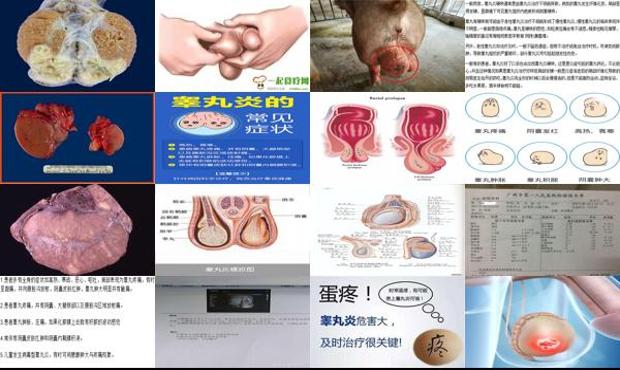 小儿睾丸炎症状及图片 - 汕头睾丸炎症状怎样的