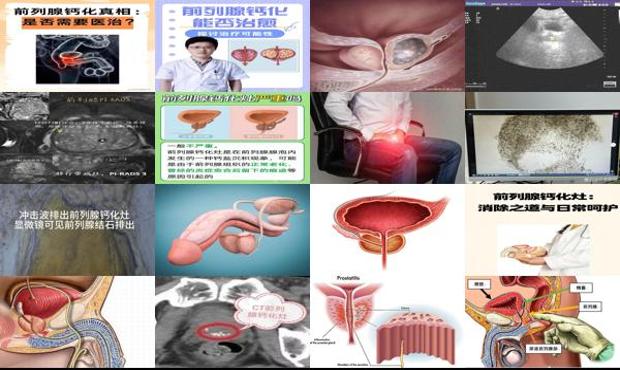 前列腺灶化怎么办 - 汕头前列腺灶化钙怎么消除