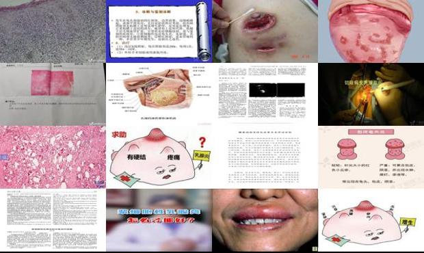 浆细胞性疾病有哪些 - 汕头浆细胞性龟头炎症状