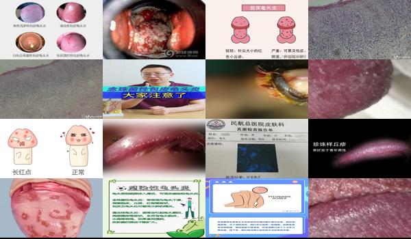 念珠菌鬼头炎的治疗方法 - 汕头念珠菌性龟头炎症状图片