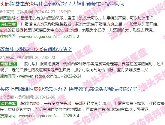 头皮炎的症状 - 汕头头皮炎症状