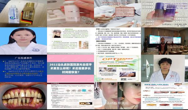 汕头哪里治疗脱发 - 汕头怎样褪炎症
