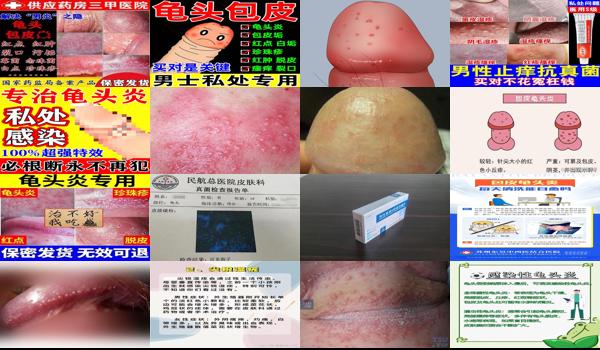 念珠性包皮炎怎么治疗 - 汕头念珠性包皮炎症状