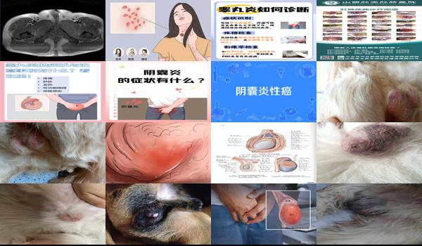 汕头阴囊炎症状医院 - 汕头阴囊炎症状