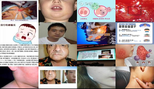 腮腺炎性睾丸炎的症状 - 汕头腮腺炎性睾丸炎症状