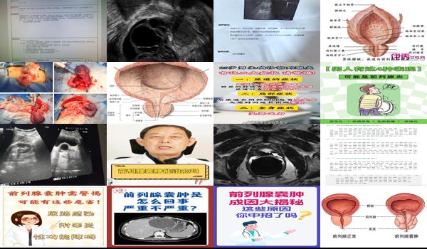 前列腺囊肿是炎症吗 - 汕头前列腺囊肿是不是炎症